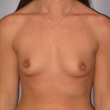 Breast Augmentation Before Patient 14