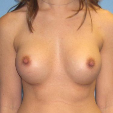 Breast Augmentation After Patient 14