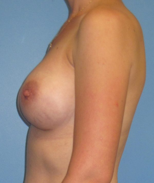 Breast Augmentation After Patient 3