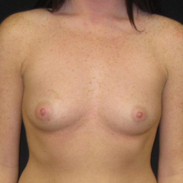 Breast Before Patient 26