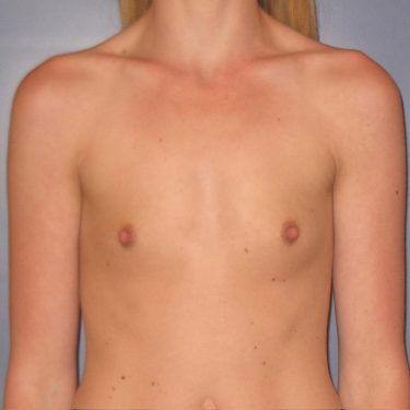 Breast Before Patient 25