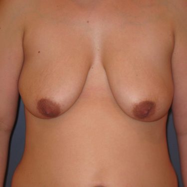 Breast Augmentation & Lift Before Patient 13
