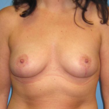 Breast Lift After Patient 28