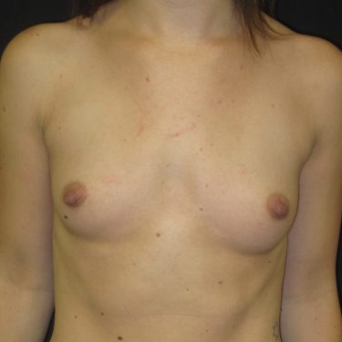 Breast Augmentation Before Patient 13