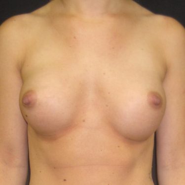 Breast Augmentation After Patient 13