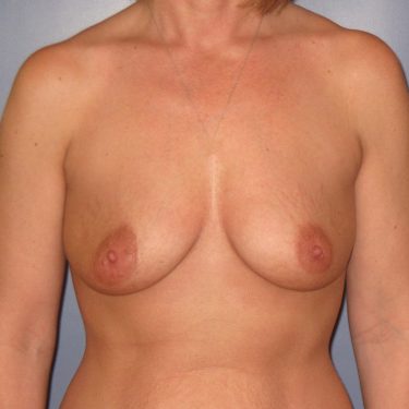 Subglandular Before Patient 15