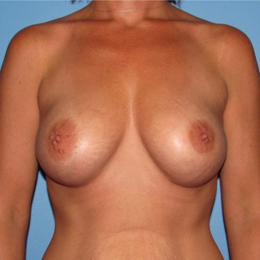 Subglandular After Patient 15