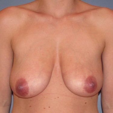 Breast Lift Before Patient 27