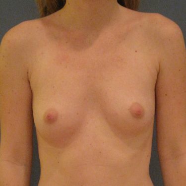 Breast Before Patient 18