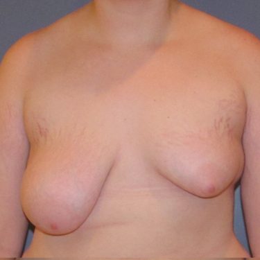 Breast Lift Before Patient 26