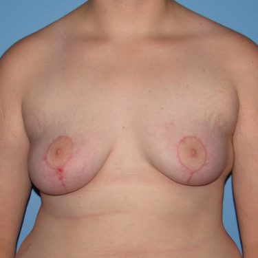 Breast Lift After Patient 26
