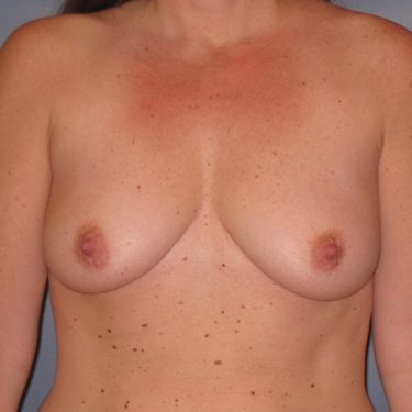 Subglandular Before Patient 14