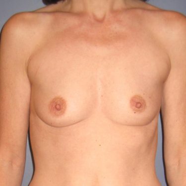 Breast Augmentation Before Patient 12