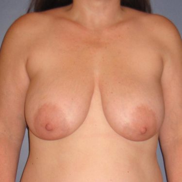 Breast Lift Before Patient 15