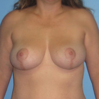 Breast Lift After Patient 15