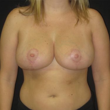 Breast Reduction After Patient 25