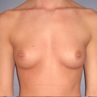 Breast Before Patient 16