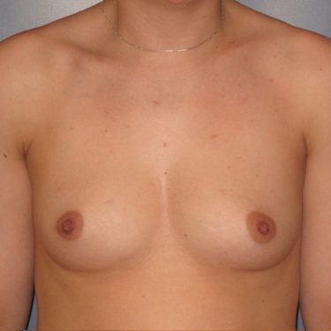 Dual-plane technique Before Patient 25