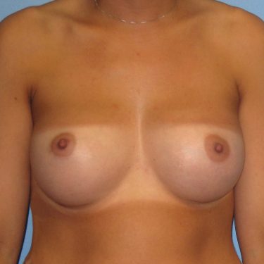 Dual-plane technique After Patient 25