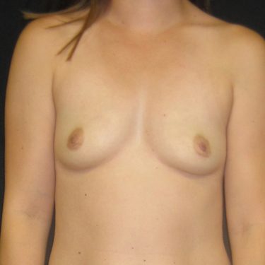 Breast Before Patient 11