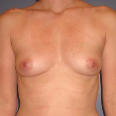 Breast Before Patient 9