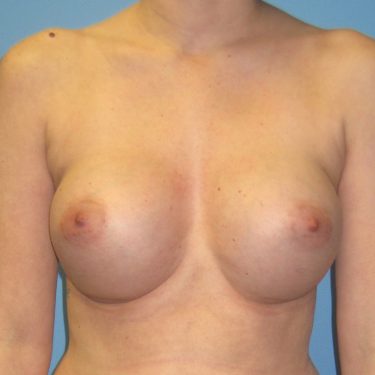 Breast After Patient 9