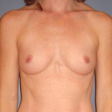 Breast Augmentation Before Patient 11