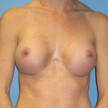 Breast Augmentation After Patient 11