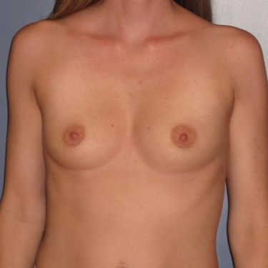 Pectus deformity Before Patient 9