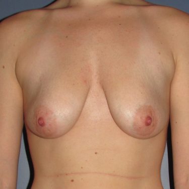 Breast Lift Before Patient 25