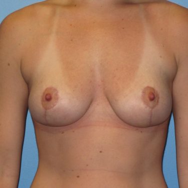 Breast Lift After Patient 25