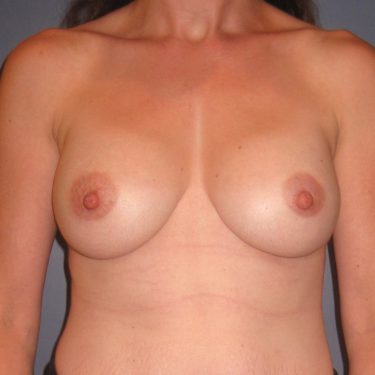 Breast Augmentation After Patient 30