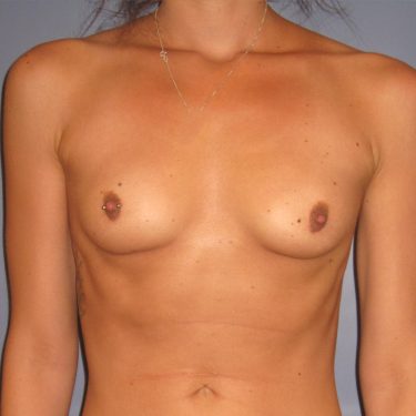Breast Augmentation Before Patient 27