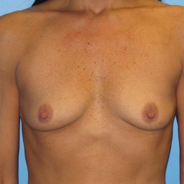 Breast Augmentation Before Patient 26