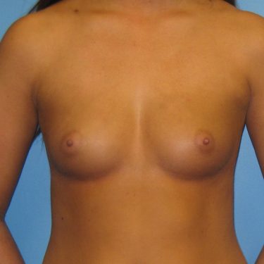 Breast Augmentation Before Patient 25