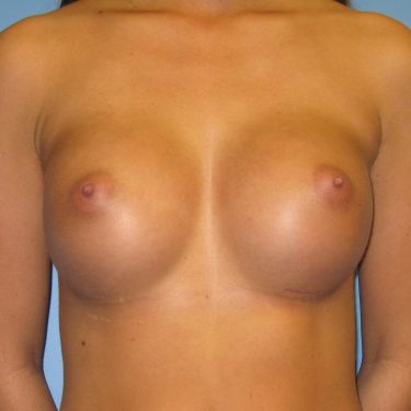 Breast Augmentation After Patient 25