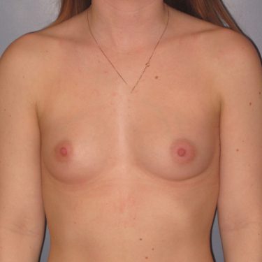 Breast Augmentation Before Patient 10