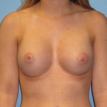 Breast Augmentation After Patient 10
