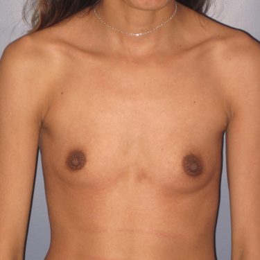 Breast Augmentation Before Patient 24
