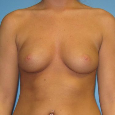 Breast Augmentation Before Patient 23