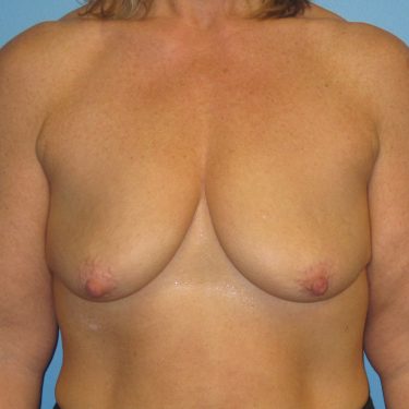 Surgery After Weight Loss Before Patient 27