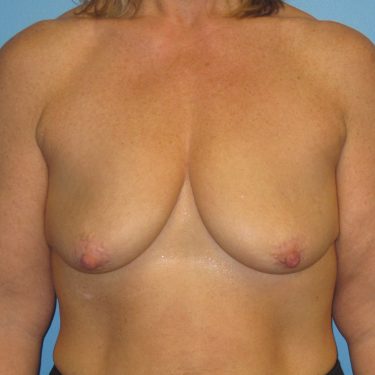 Surgery After Weight Loss Before Patient 29