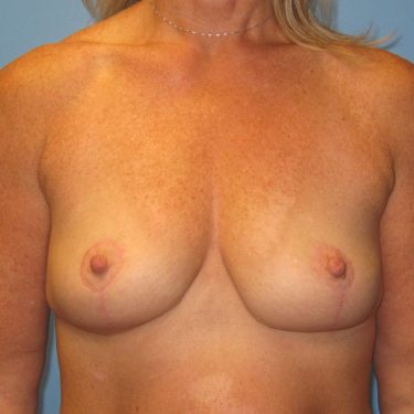 Surgery After Weight Loss After Patient 29