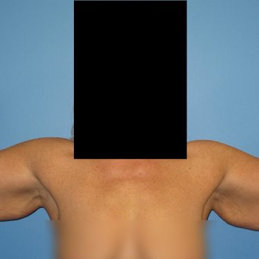 Brachioplasty Before Patient 5