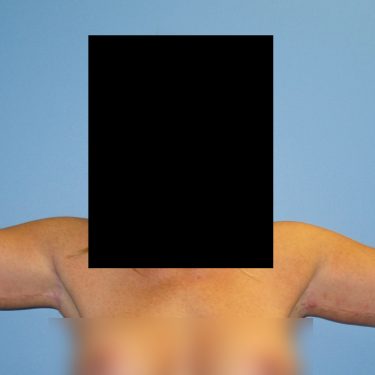 Brachioplasty After Patient 5
