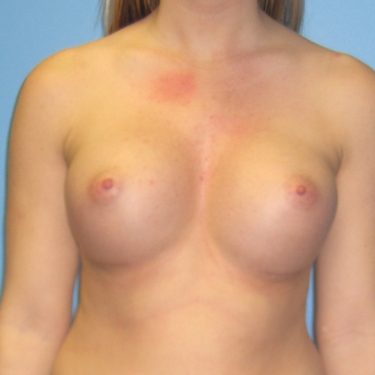 Breast Augmentation After Patient 19