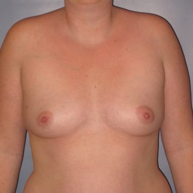 Breast Augmentation Before Patient 9