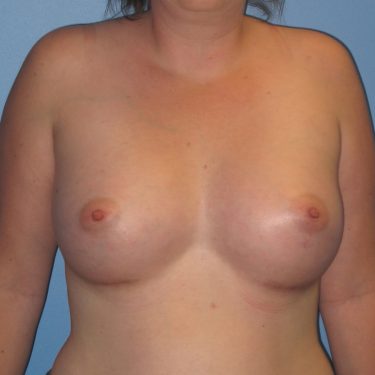 Breast Augmentation After Patient 9