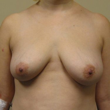 Breast Lift Before Patient 20