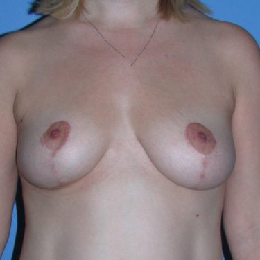 Breast Lift After Patient 20